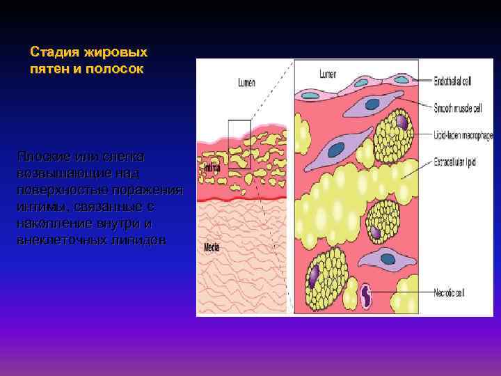 Стадия жировых пятен и полосок Плоские или слегка возвышающие над поверхностью поражения интимы, связанные