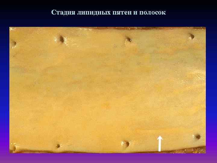 Стадия липидных пятен и полосок 