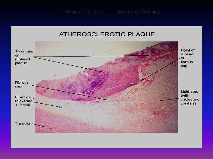 Строение атеросклеротической бляшки 