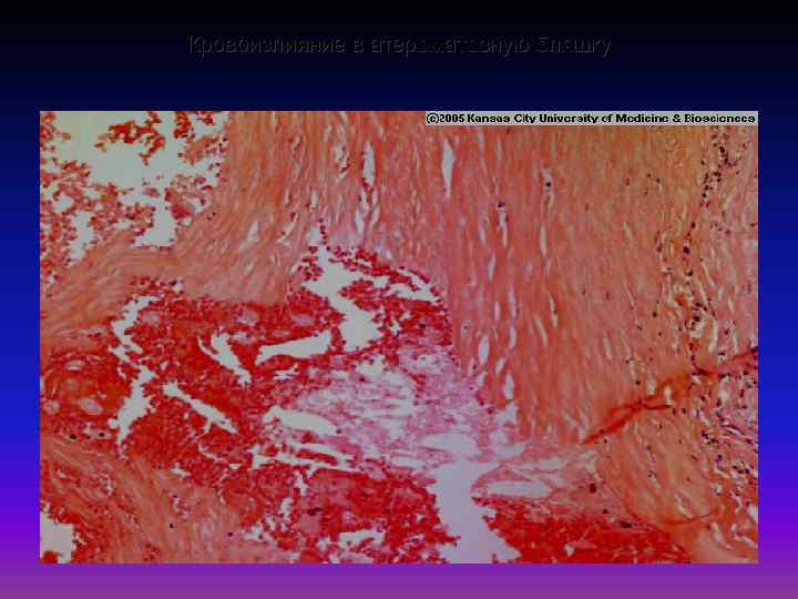 Кровоизлияние в атероматозную бляшку 