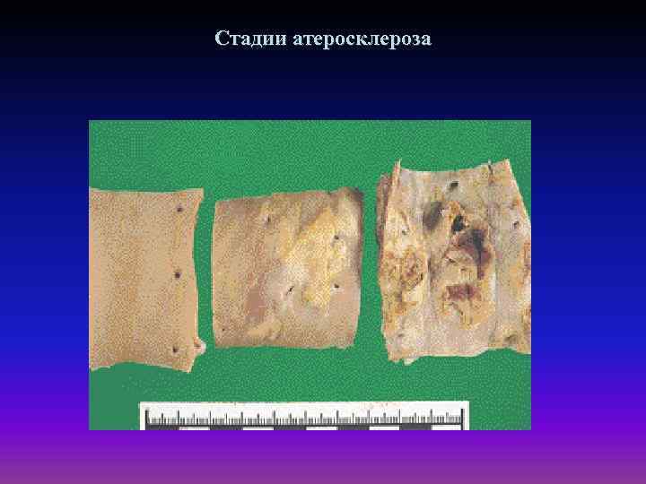 Стадии атеросклероза 