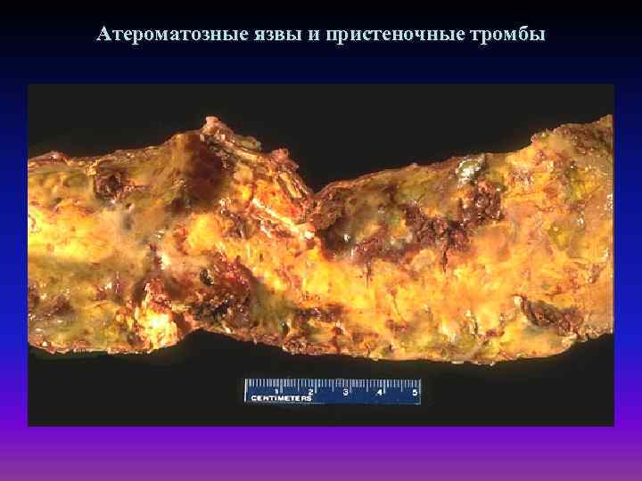 Атероматозные язвы и пристеночные тромбы 