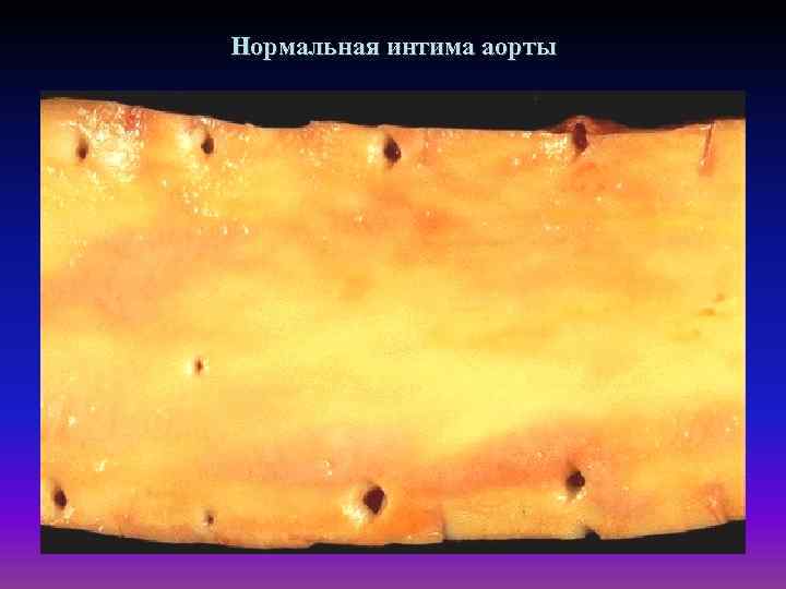 Нормальная интима аорты 