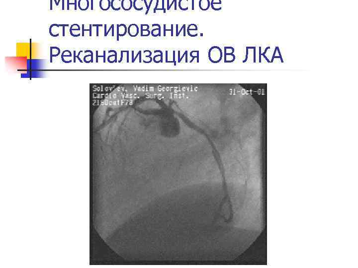 Многососудистое стентирование. Реканализация ОВ ЛКА 