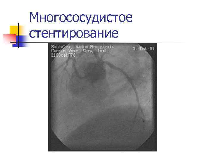 Многососудистое стентирование 