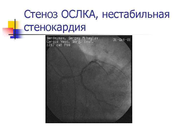Стеноз ОСЛКА, нестабильная стенокардия 