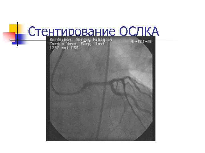 Стентирование ОСЛКА 