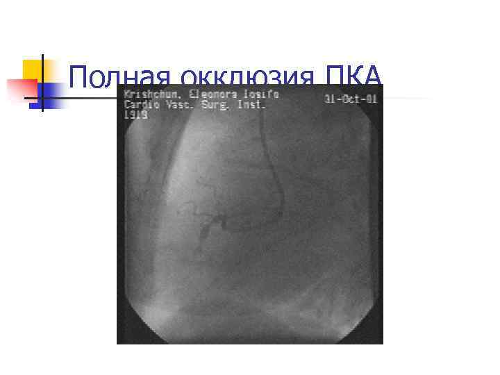 Полная окклюзия ПКА 