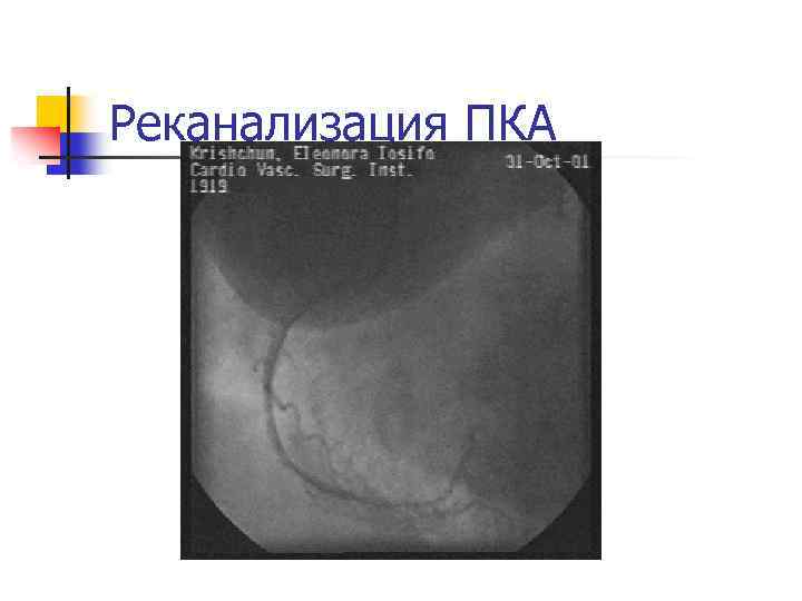 Реканализация ПКА 