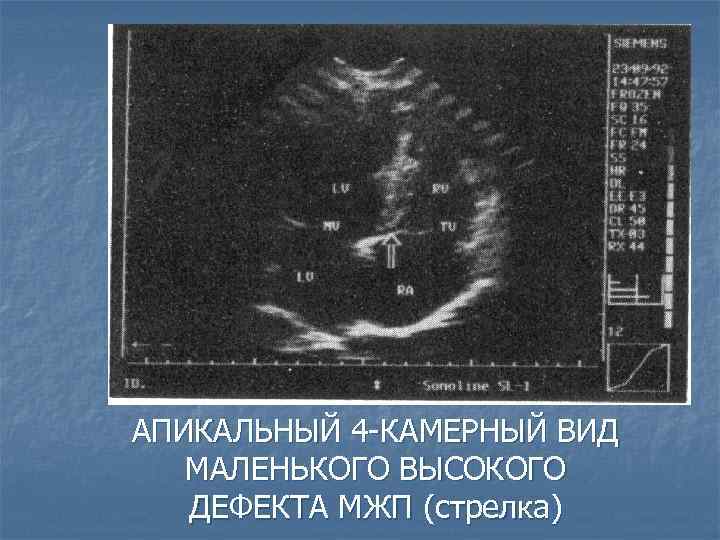 АПИКАЛЬНЫЙ 4 -КАМЕРНЫЙ ВИД МАЛЕНЬКОГО ВЫСОКОГО ДЕФЕКТА МЖП (стрелка) 