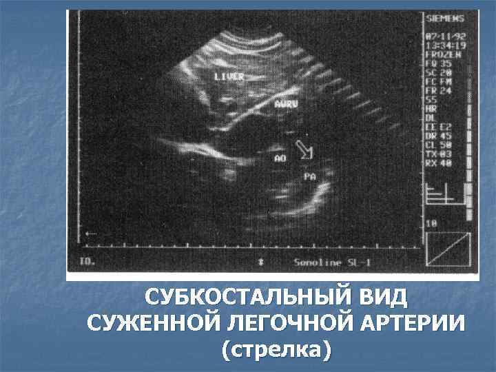 СУБКОСТАЛЬНЫЙ ВИД СУЖЕННОЙ ЛЕГОЧНОЙ АРТЕРИИ (стрелка) 