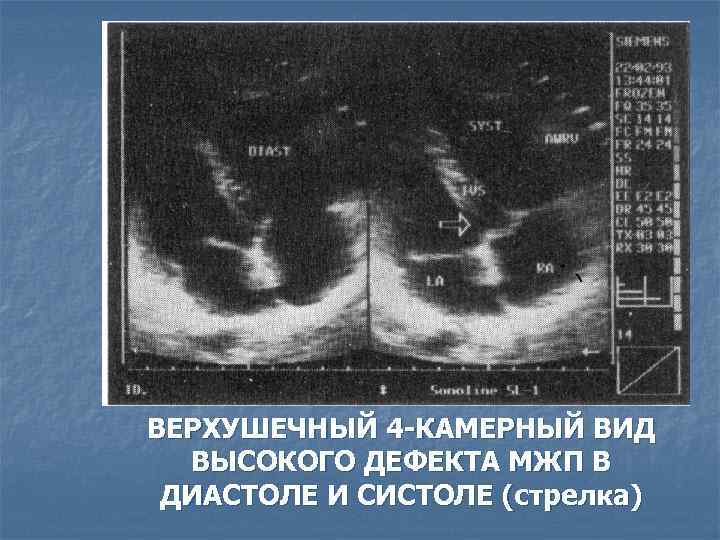 ВЕРХУШЕЧНЫЙ 4 -КАМЕРНЫЙ ВИД ВЫСОКОГО ДЕФЕКТА МЖП В ДИАСТОЛЕ И СИСТОЛЕ (стрелка) 