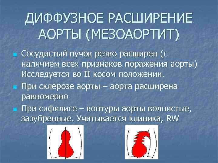 ДИФФУЗНОЕ РАСШИРЕНИЕ АОРТЫ (МЕЗОАОРТИТ) n n n Сосудистый пучок резко расширен (с наличием всех