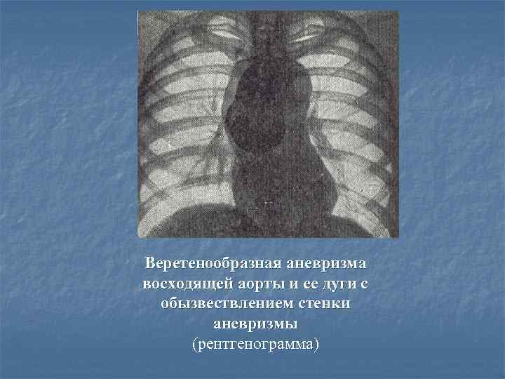 Веретенообразная аневризма восходящей аорты и ее дуги с обызвествлением стенки аневризмы (рентгенограмма) рентгенограмма 