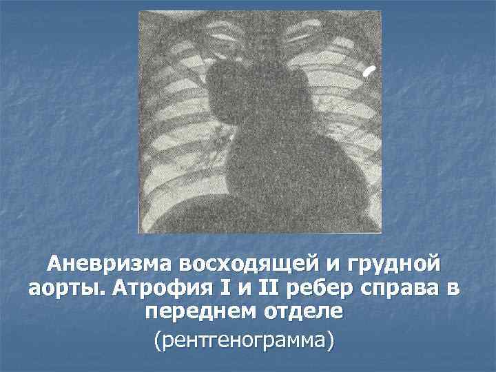 Аневризма восходящей и грудной аорты. Атрофия I и II ребер справа в переднем отделе