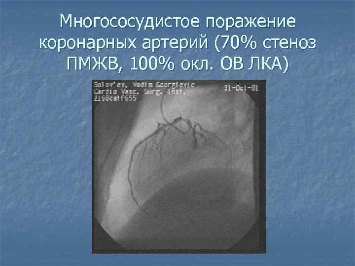 Многососудистое поражение коронарных артерий (70% стеноз ПМЖВ, 100% окл. ОВ ЛКА) 