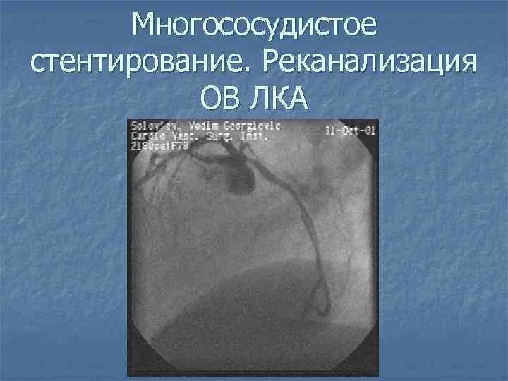 Многососудистое стентирование. Реканализация ОВ ЛКА 