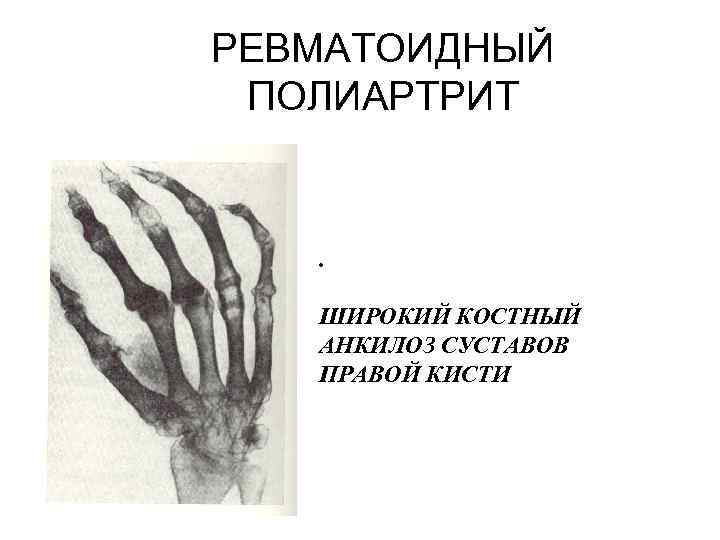 РЕВМАТОИДНЫЙ ПОЛИАРТРИТ . ШИРОКИЙ КОСТНЫЙ АНКИЛОЗ СУСТАВОВ ПРАВОЙ КИСТИ 