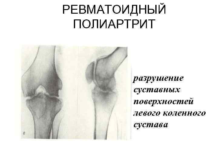 РЕВМАТОИДНЫЙ ПОЛИАРТРИТ разрушение суставных поверхностей левого коленного сустава 
