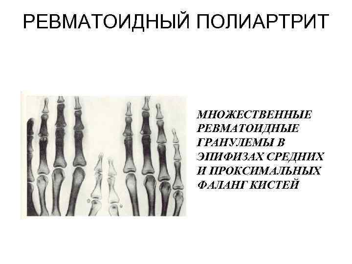 РЕВМАТОИДНЫЙ ПОЛИАРТРИТ МНОЖЕСТВЕННЫЕ РЕВМАТОИДНЫЕ ГРАНУЛЕМЫ В ЭПИФИЗАХ СРЕДНИХ И ПРОКСИМАЛЬНЫХ ФАЛАНГ КИСТЕЙ 