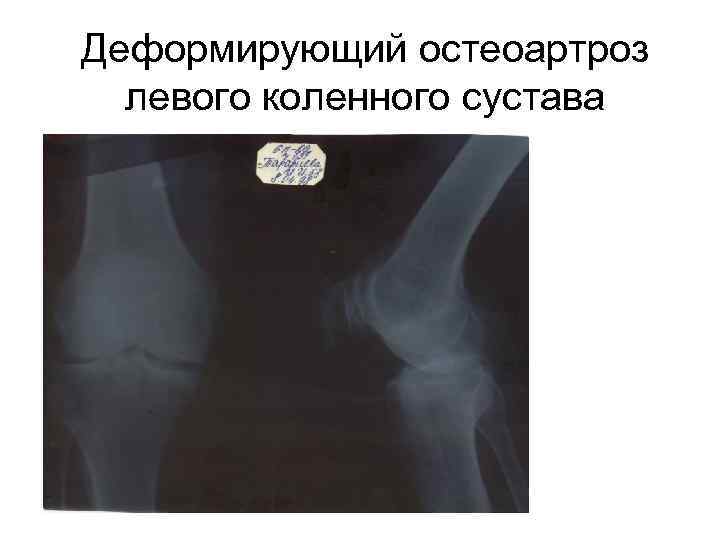 Деформирующий остеоартроз левого коленного сустава 