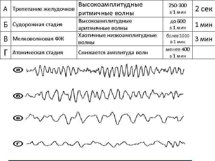 А Трепетание желудочков Б Судорожная стадия В Мелковолновая ФЖ Г Атоническая стадия Высокоамплитудные ритмичные