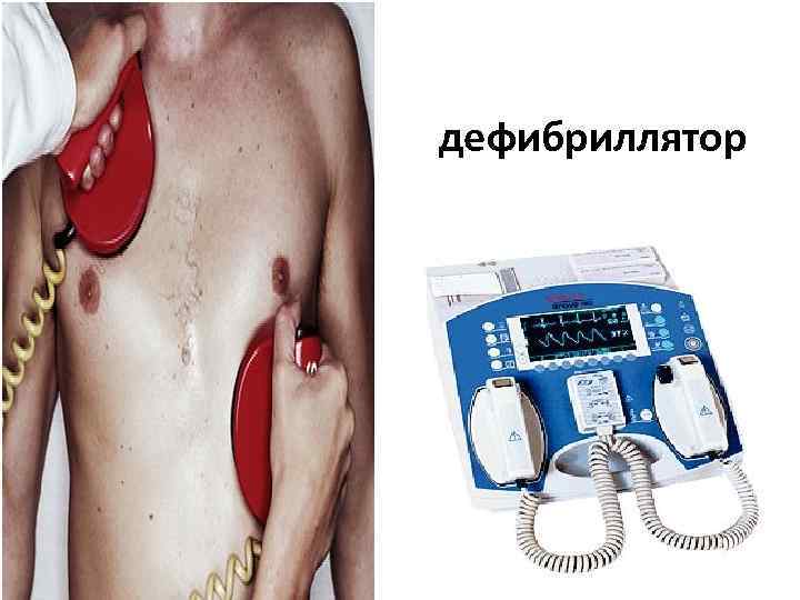 дефибриллятор 