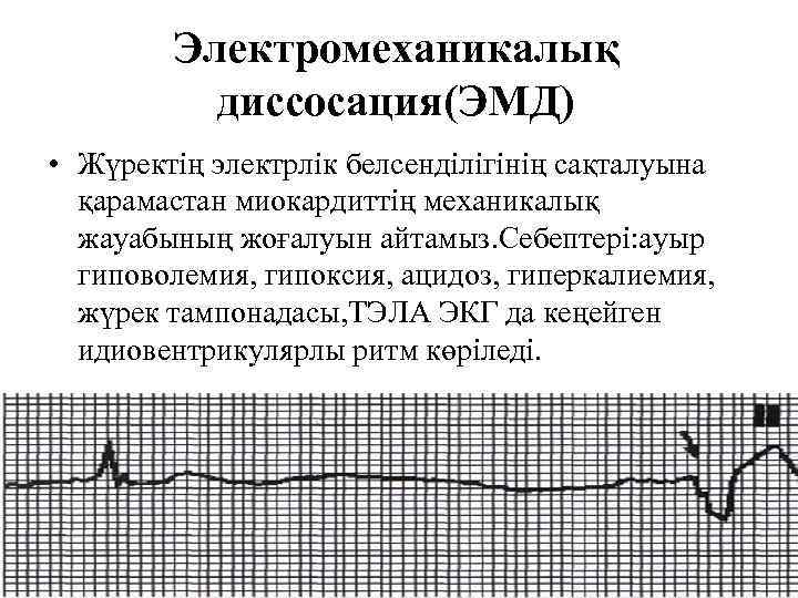 Признаки электромеханической диссоциации