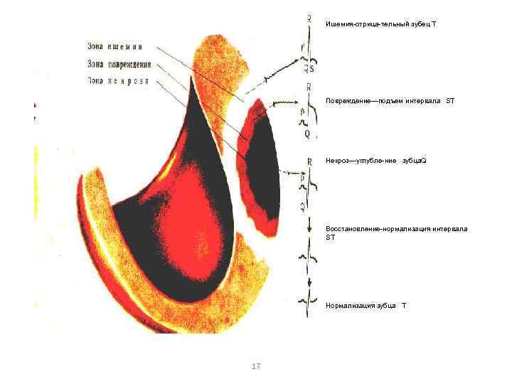 Зона и ш е м и Ишемия отрица тельный зубец Т и Повреждение—подъем интервала