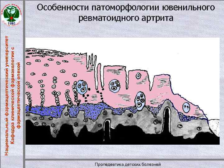 Национальный фармацевтический университет Кафедра клинической фармакологии с фармацевтической опекой Особенности патоморфологии ювенильного ревматоидного артрита