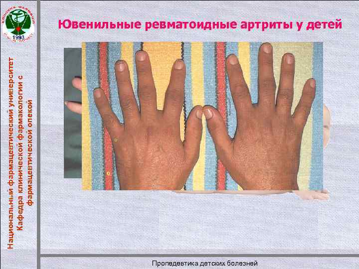 Национальный фармацевтический университет Кафедра клинической фармакологии с фармацевтической опекой Ювенильные ревматоидные артриты у детей