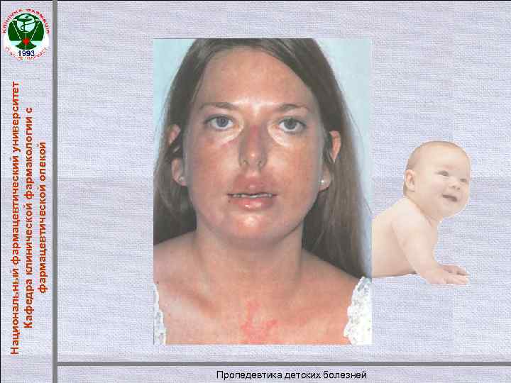 Пропедевтика детских болезней Национальный фармацевтический университет Кафедра клинической фармакологии с фармацевтической опекой 