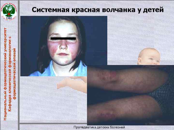 Национальный фармацевтический университет Кафедра клинической фармакологии с фармацевтической опекой Сиcтемная красная волчанка у детей