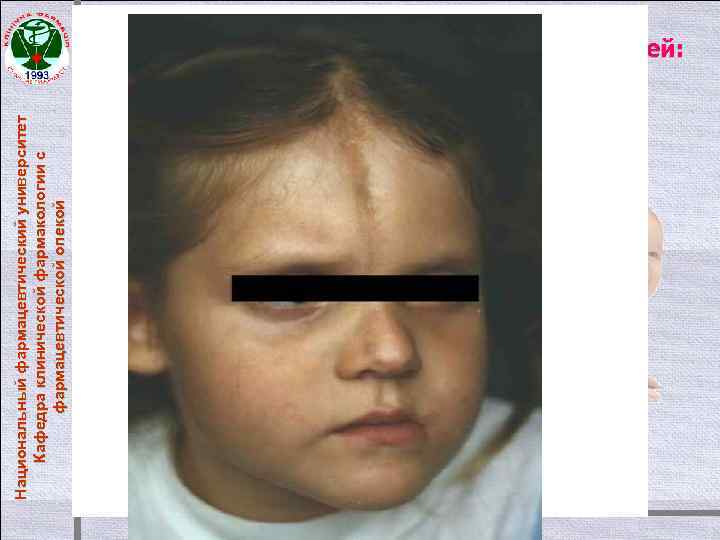 Национальный фармацевтический университет Кафедра клинической фармакологии с фармацевтической опекой Заболевания соединительной ткани у детей: