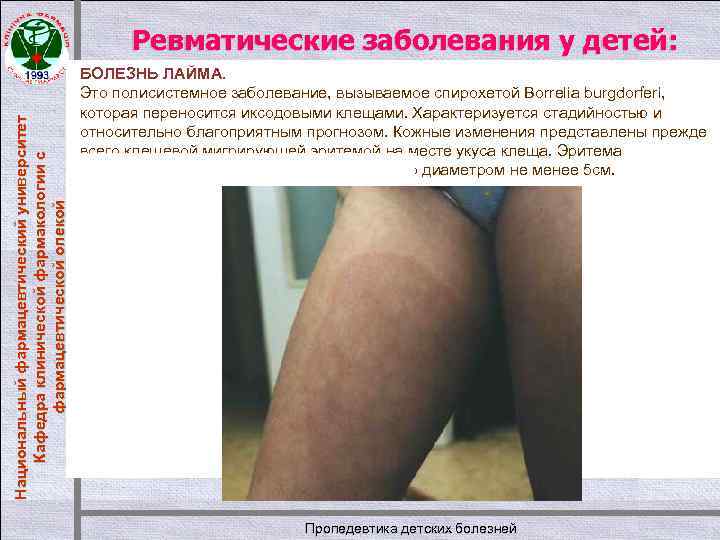 Национальный фармацевтический университет Кафедра клинической фармакологии с фармацевтической опекой Ревматические заболевания у детей: БОЛЕЗНЬ