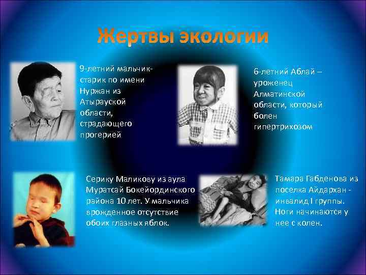 9 -летний мальчикстарик по имени Нуржан из Атырауской области, страдающего прогерией Серику Маликову из