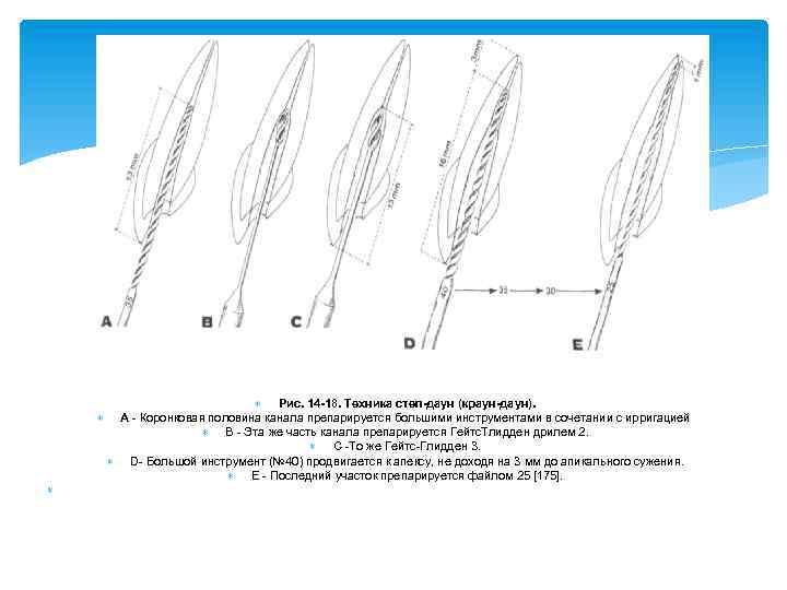  Рис. 14 -18. Техника степ-даун (краун-даун). А Коронковая половина канала препарируется большими инструментами