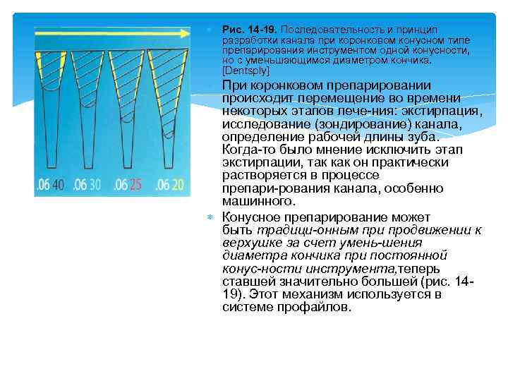  Рис. 14 -19. Последовательность и принцип разработки канала при коронковом конусном типе препарирования