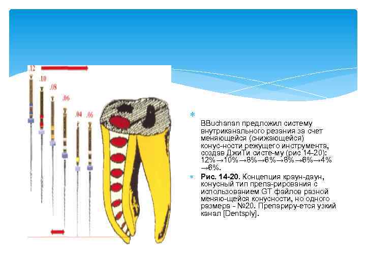  BBuchanan предложил систему внутриканального резания за счет меняющейся (снижающейся) конус ности режущего инструмента,