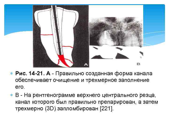  Рис. 14 -21. А Правильно созданная форма канала обеспечивает очищение и трехмерное заполнение