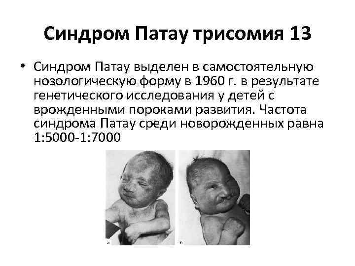 Синдром Патау трисомия 13 • Синдром Патау выделен в самостоятельную нозологическую форму в 1960