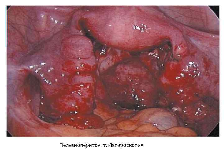 Пельвиоперитонит. Лапароскопия 