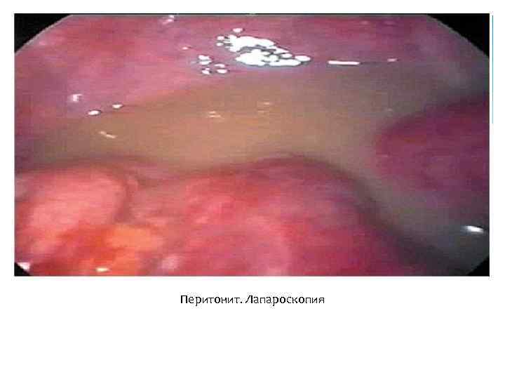  Перитонит. Лапароскопия 
