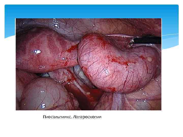 Пиосальпинкс. Лапароскопия 