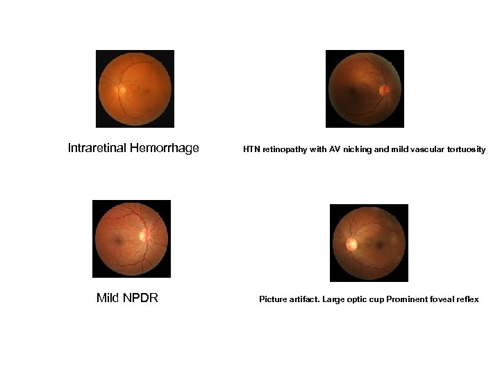 Intraretinal Hemorrhage Mild NPDR HTN retinopathy with AV nicking and mild vascular tortuosity Picture