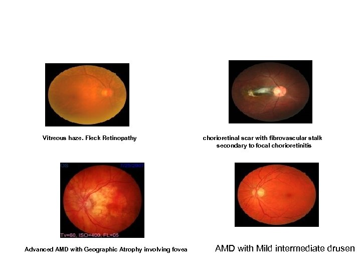 Vitreous haze. Fleck Retinopathy Advanced AMD with Geographic Atrophy involving fovea chorioretinal scar with