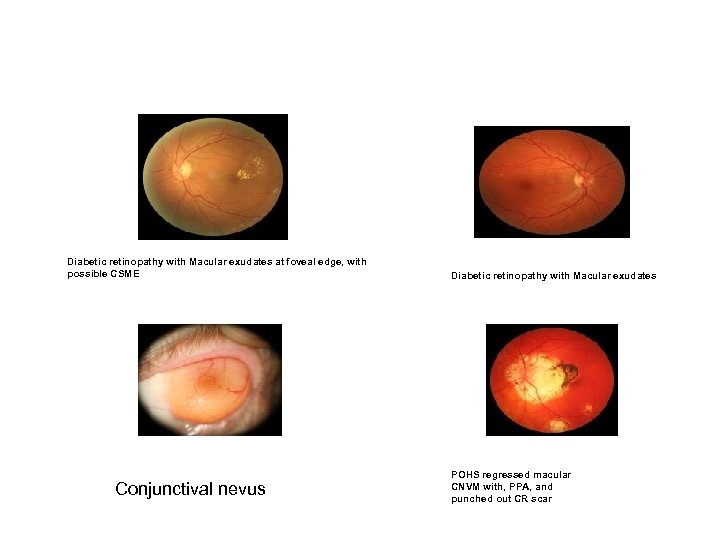 Diabetic retinopathy with Macular exudates at foveal edge, with possible CSME Conjunctival nevus Diabetic