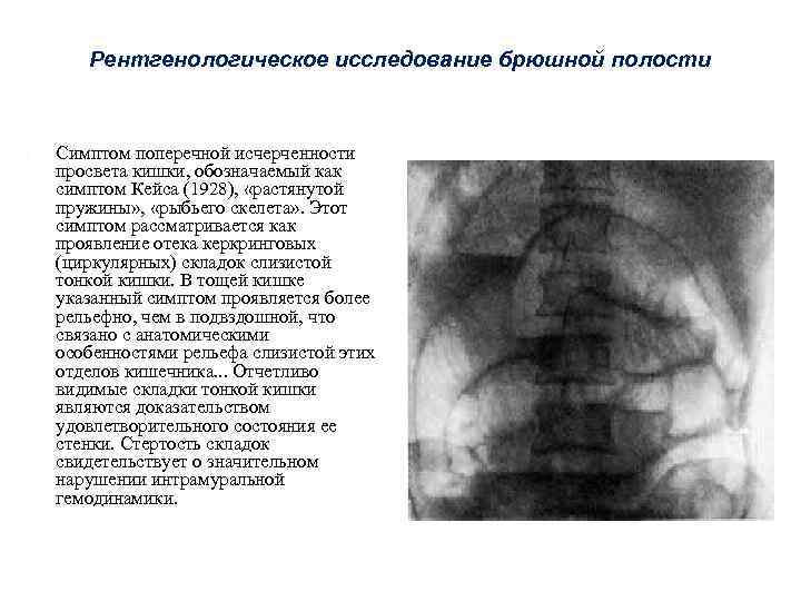 Симптомы брюшной полости. Симптом керкринговых складок. Рыбий скелет при кишечной непроходимости. Абдоминальное рентгенологическое исследование. Симптом поперечной исчерченности.