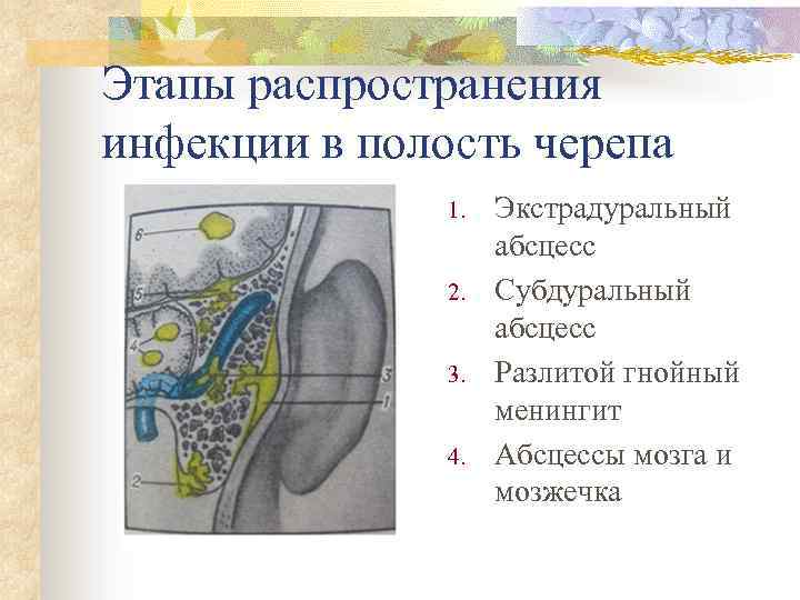 Этапы распространения инфекции в полость черепа 1. 2. 3. 4. Экстрадуральный абсцесс Субдуральный абсцесс