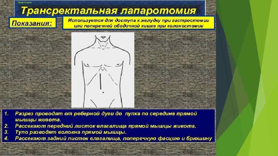 Лапаротомия 